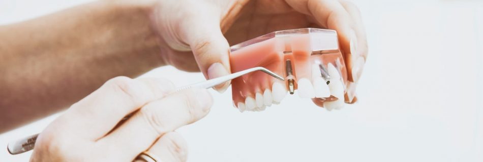 Pemasangan Gigi Palsu untuk mengembalikan fungsi gigi