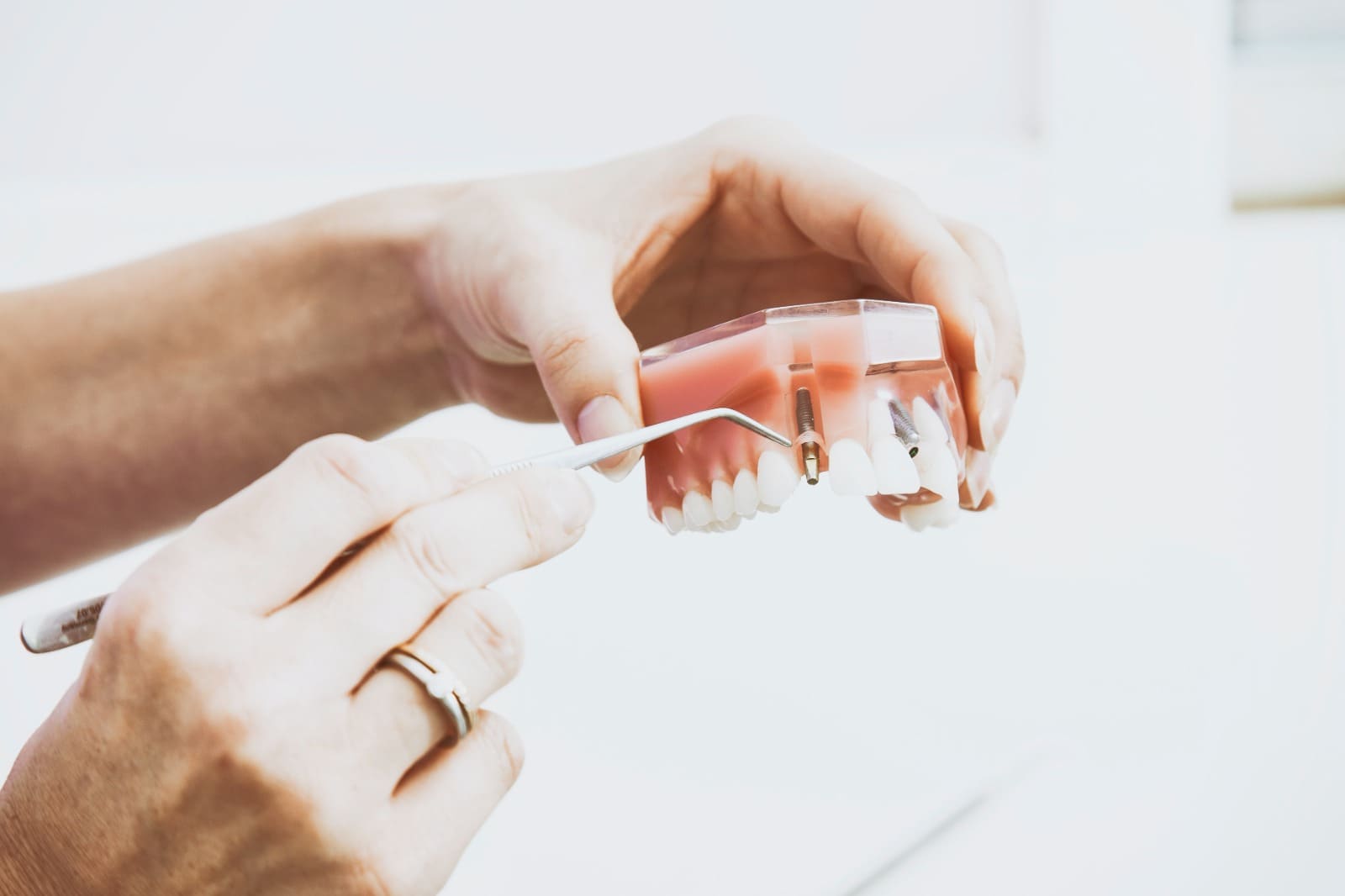 Pemasangan Gigi Palsu untuk mengembalikan fungsi gigi